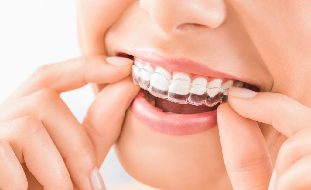 How Long Does Invisalign Take? What to Expect Month by Month