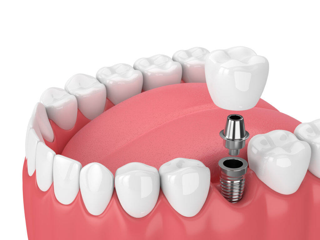 Full-Mouth Dental Implants vs Dentures: Long-Term Comfort & Maintenance
