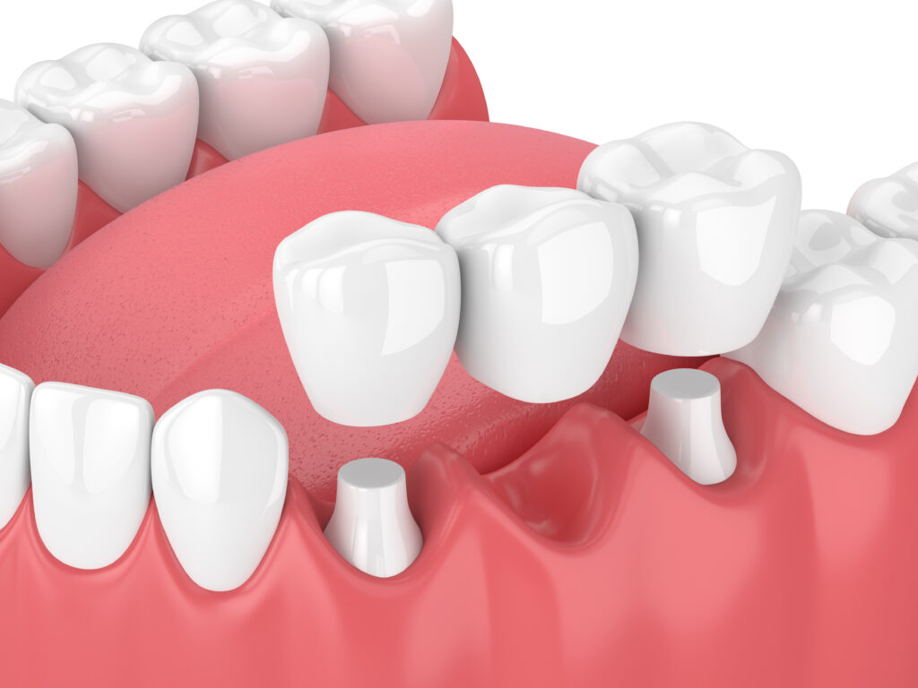 Dental Implants vs Bridges: Which Replacement Option Lasts Longer?