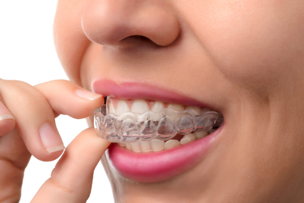 5 Surprising Facts About Invisalign You May Not Know