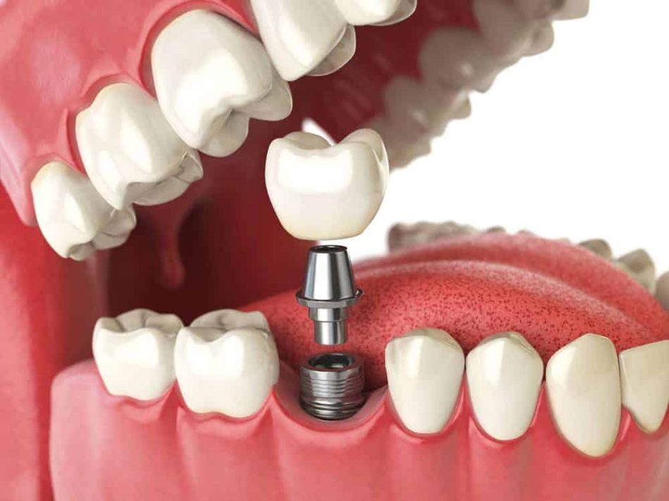 dental-implants-marina-dentistry