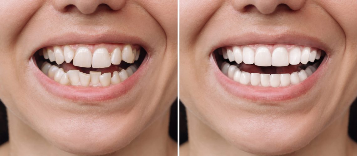 Cropped shot of a young caucasian smiling woman before and after veneers installation. Teeth whitening. Dentistry, dental treatment. Сorrection of uneven teeth with braces