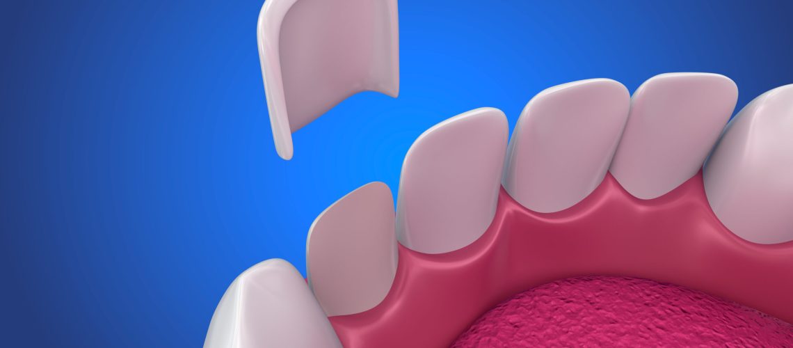 Dental Veneers: Porcelain Veneer installation Procedure. 3D illustration
