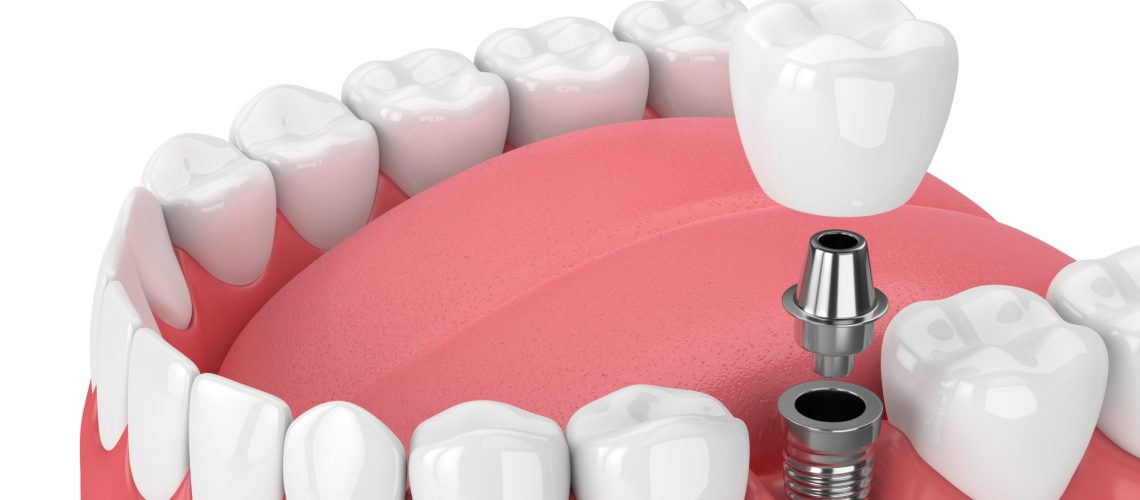 3d render of jaw with teeth and dental molar implant over white background