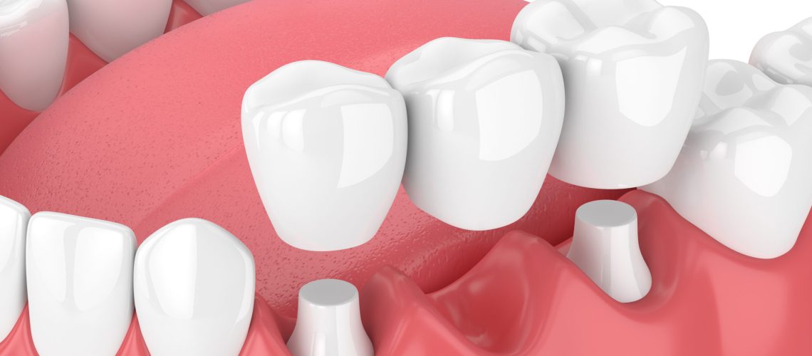 3d render of jaw with dental bridge  over white background