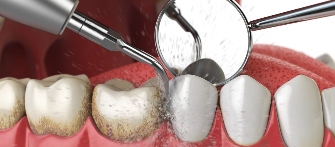 Professional teeth cleaning. Ultrasonic teeth cleaning machine delete dental calculus from human teeth. 3d illustration
