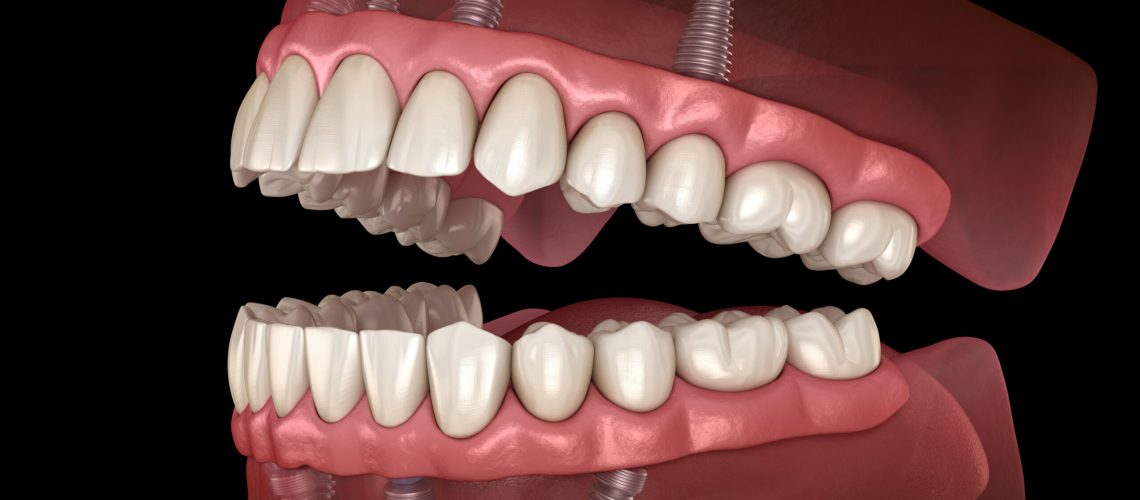 Maxillary and Mandibular prosthesis with gum All on 4 system supported by implants. Medically accurate 3D illustration of human teeth and dentures