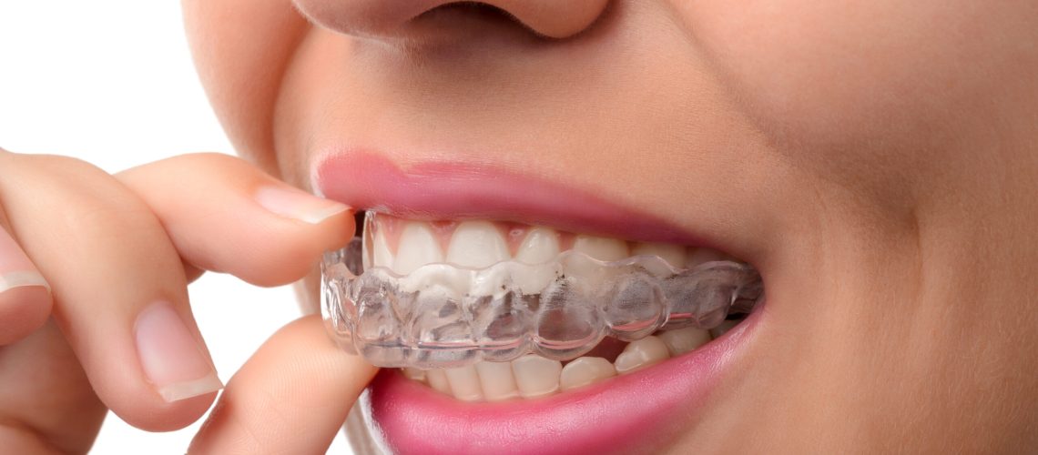 Woman wearing orthodontic silicone trainer. Invisible braces