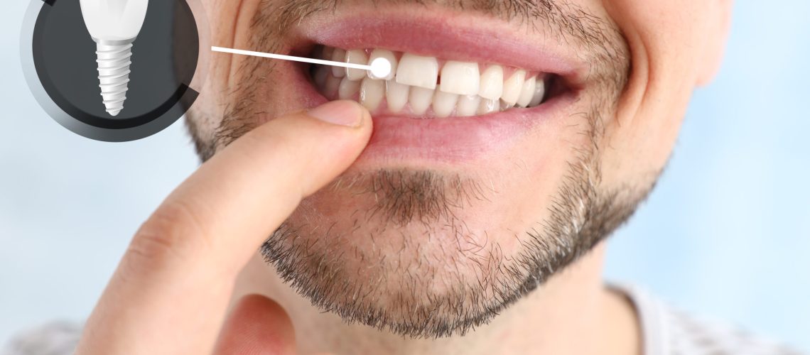 Man showing implanted teeth on light background, closeup