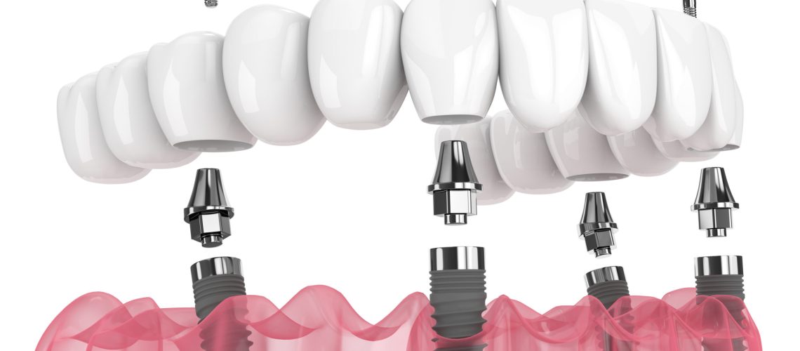 Mandibular prosthesis all on 4 system supported by implants over white background