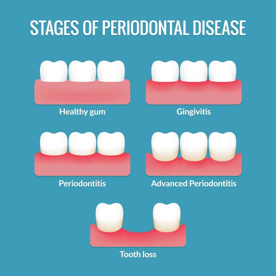 periodontal-disease-marina-dentistry